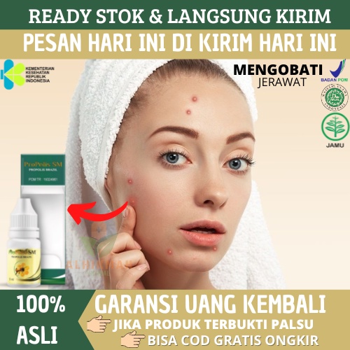 Obat Oles Jerawat, Obat Totol Jerawat, Obat Jerawat, Obat Penghilang Luka Jerawat, Obat Jerawat Bern