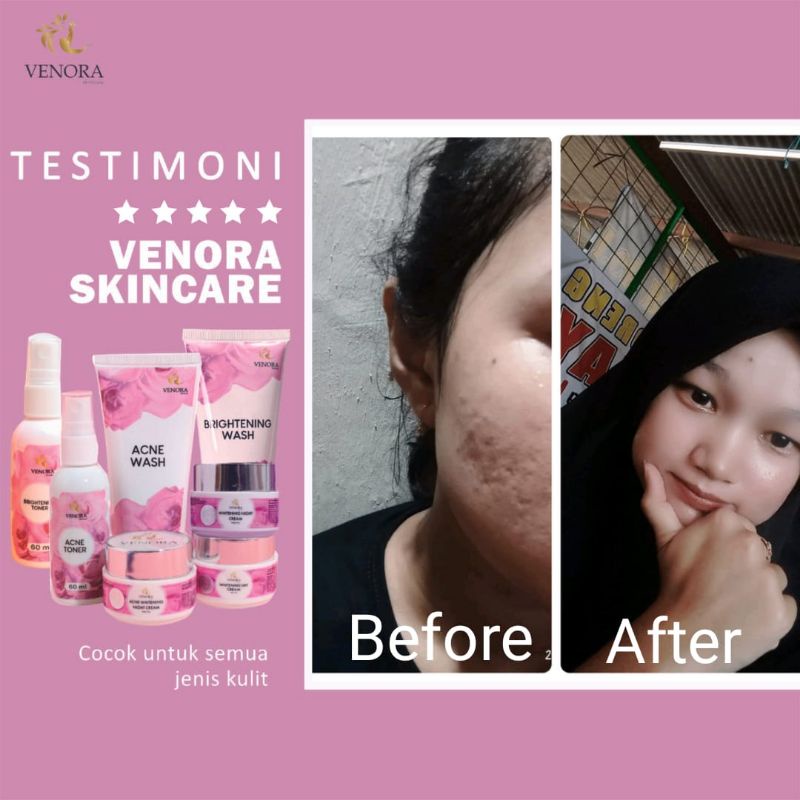 TERLARIS ! VENORA SKINCARE / OBAT JERAWAT / ACNE LOTION / OBAT KERAWAT VENORA / MENGOBATI JERAWAT / MENGHILANGKAN BEKAS JERAWAT / BEBAS JERAWAT / PORI PORI BESAR / TOTOL JERAWAT / PENGHILANG JERAWAT