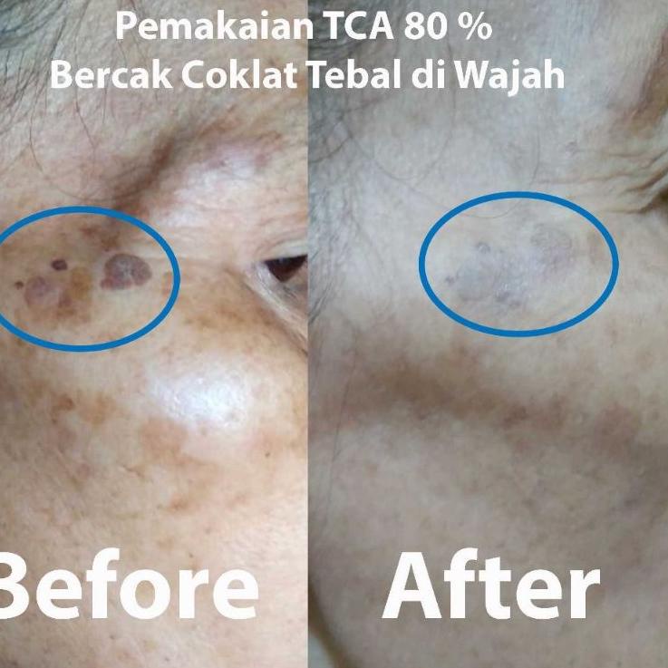 [PRODUK 00LUS] Kutil TCA 80% LQC