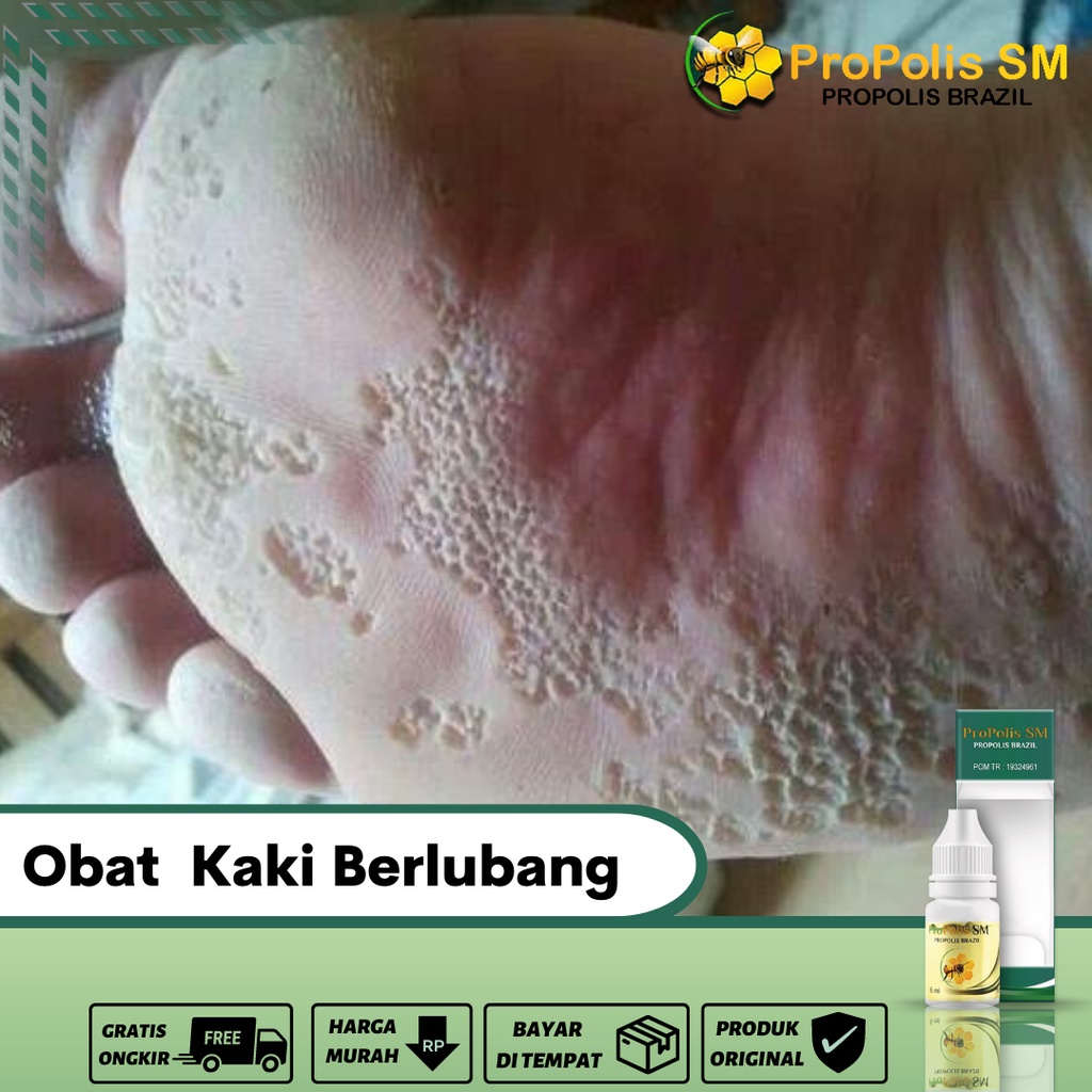 Obat Kaki Berlubang, Obat Pengelupas Kaki Berlubang, Obat Kaki Berlubang Akibat Rayap, Obat Telapak 