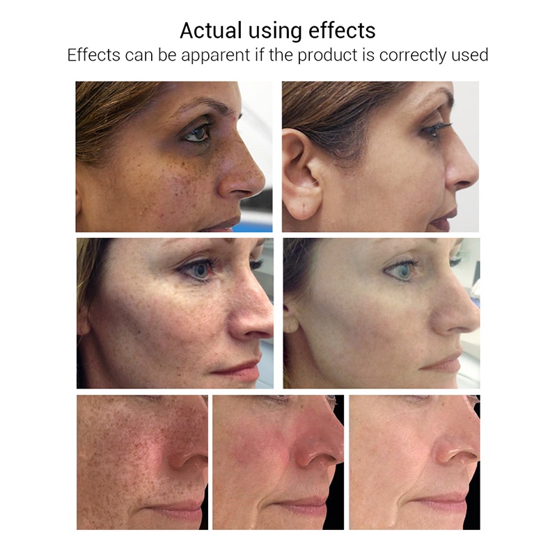 Penghilang flek hitam di wajah ampuh bpom menghilangkan bintik bintik di wajah Melasma Ampuh Remedy Black Spots tanpa melukai kulit Whitening Freckle