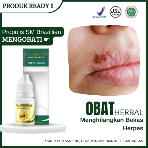 Obat Menghilangkan Bekas Herpes Menghitam - Salep Penghilang Bekas Luka Herpes Di Leher Punggung Mul