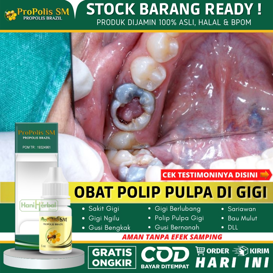 Obat Polip Pulpa Gigi Alami Untuk Anak & Dewasa, Obat Polip Gigi, Polip Pulpa Gigi, Polip Gusi, Gusi