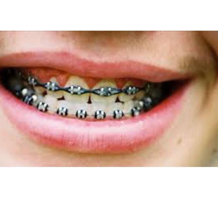 KODE-JO22 1 paket behel permanen lengkap original + lem non laser (GiC) + Sonde + mouthgate + bonus 