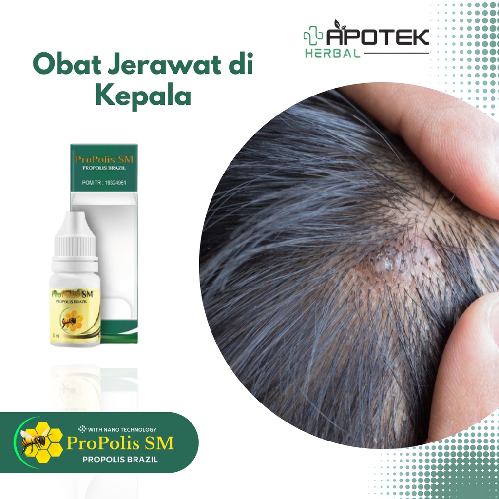 Obat Jerawat di Kepala, Benjolan Bernanah di Kepala, Bisul di Kepala, Cenang di Kepala, Obat Tetes J