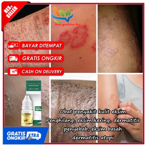 Obat penyakit kulit eksim, Penghilang, eksim kering, dermatitis, penyebab, eksim basah, dermatitis a