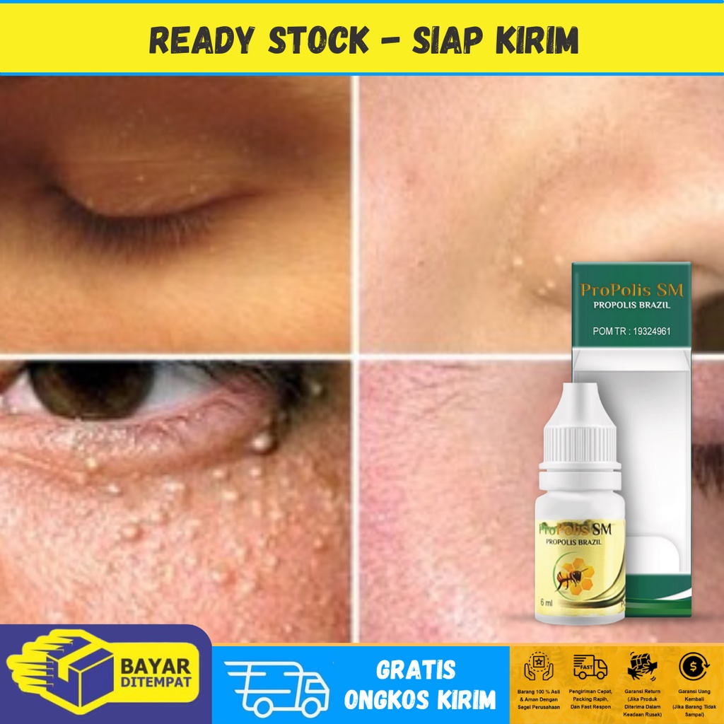 Obat Oles Milia, Obat Penghilang Milia, Obat Milia diarea Mata, Obat Milia di Bawah Mata, Obat Milia