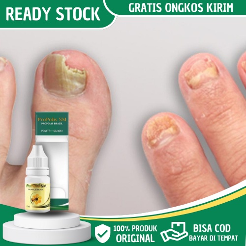Obat Tetes Kuku Berjamur - Obat Jamur Kuku, Obat Kuku Rusak, Obat Kuku Kering, Obat Kuku Kuning, Oba