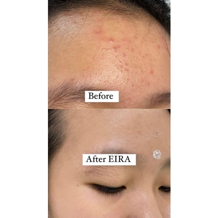 EIRA ACNE SET (3in1)