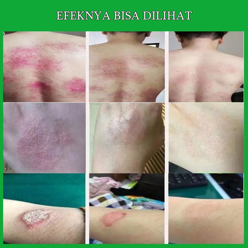 Salep gatal Salep Eksim Salep kulit Krim psoriasis paling ampuh Kulit Kepala Psoriasis Tangan Tinea Kaki Bau Versicolor Menghambat Dermatitis Jamur Anti Gatal Cream 30G