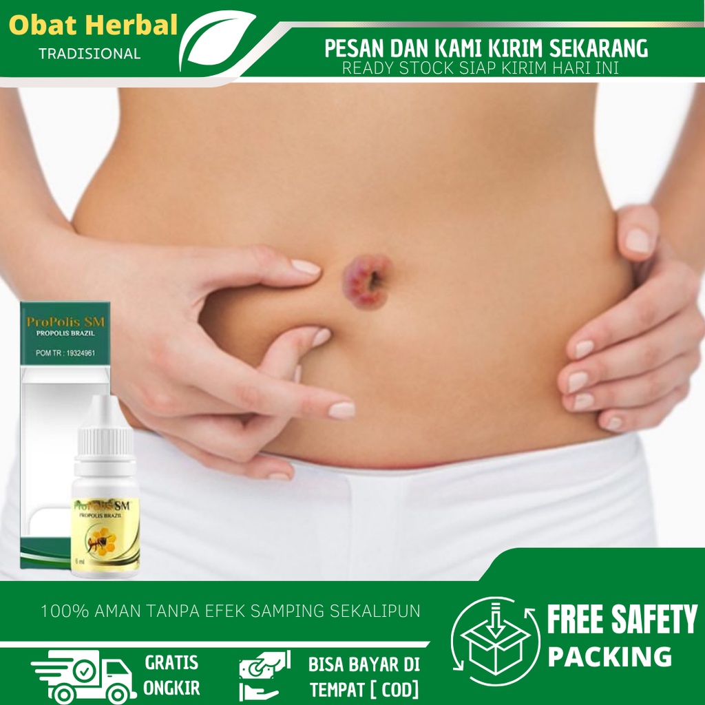 Obat Pusar Bernanah dab Bau Busuk, Pusar Berair, Obat Pusar Bengkak Untuk Anak, Bisul Di Pusar, Obat