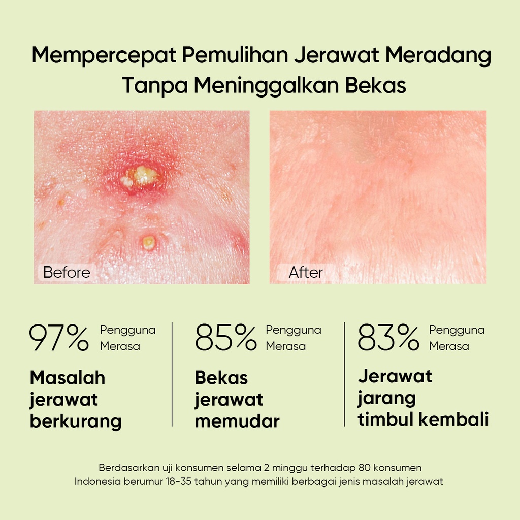 TERMURAH SKINTIFIC - Acne Treatment Series Paket Anti Jerawat Acne Spot Gel + Mugwort Mud Mask Pores Wash Off Pack with Salicylic acid/Niacinamide Repair Skin Barrier