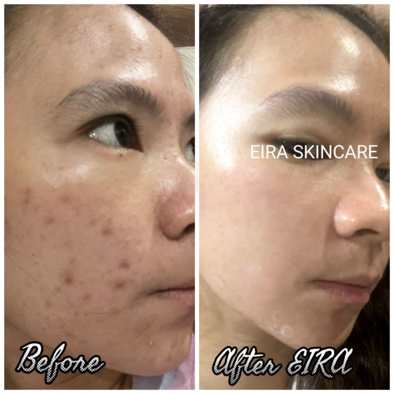 EIRA ACNE SET (3in1)