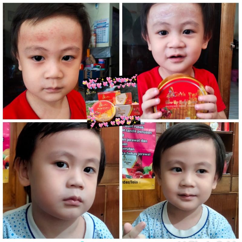 salep gatal-gatal, panu kadas,kurap DNA SALMON GRYA BEAUTY paket hemat