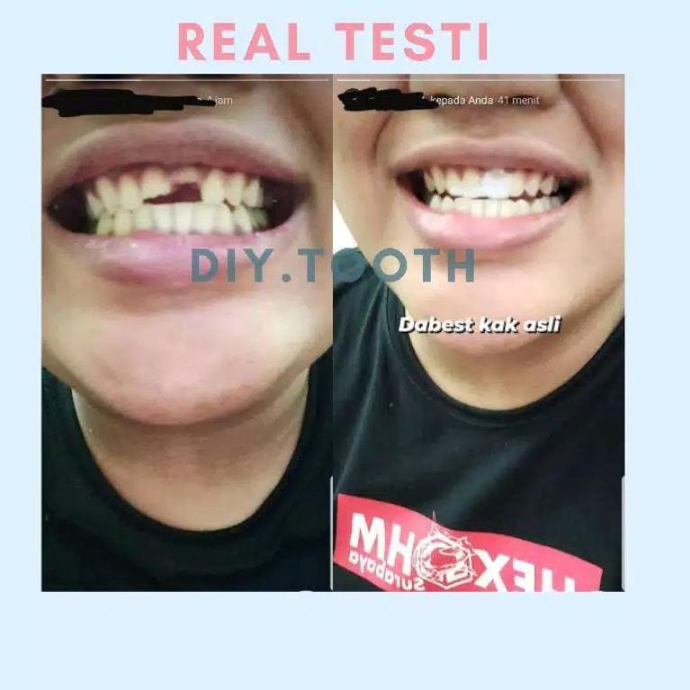 LBS.18Oc22ᴶ ‑ DIY TOOTH gigi palsu sementara / bisa dibentuk sendiri / veener sementara /  lem gigi 