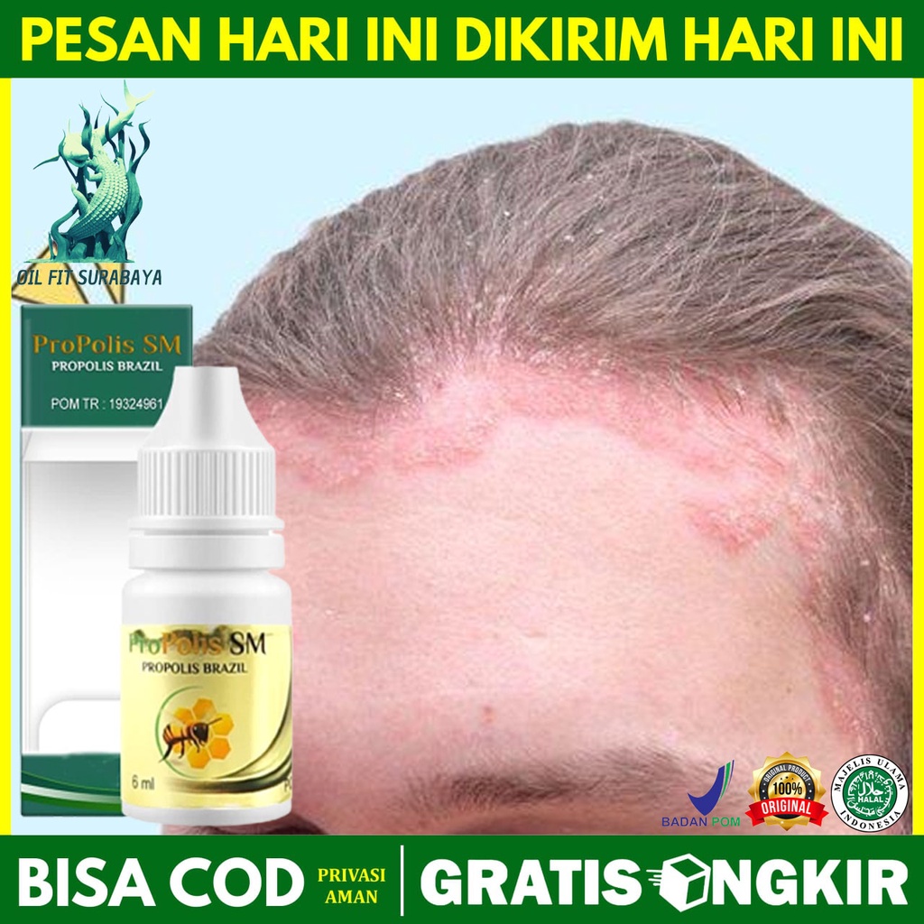 (BISA COD) Obat Oles Tetes Kulit Kepala Berkerak Bersisik Mengelupas, Obat Kulit Kepala Kering, Obat