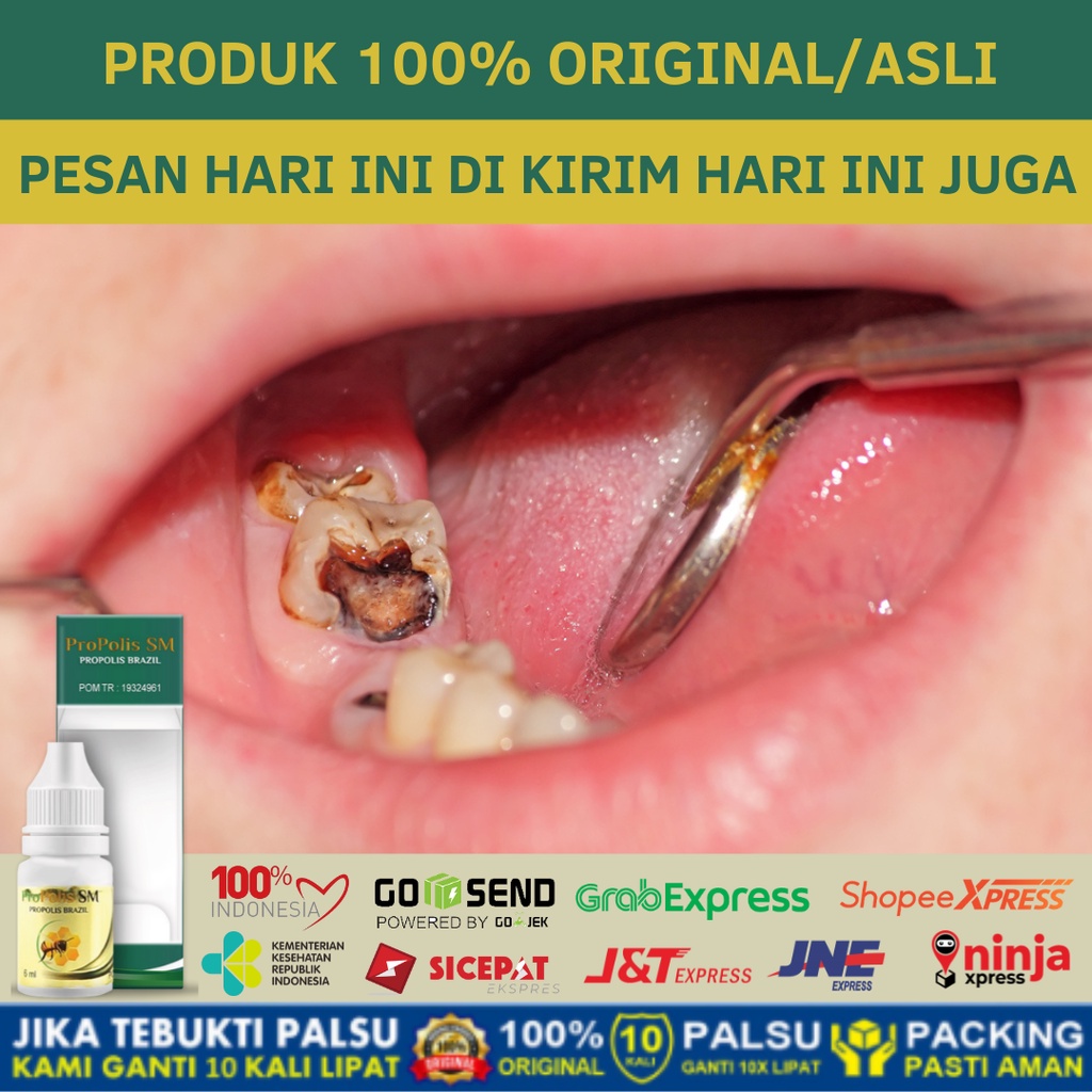 Jual Obat Sakit Gigi Berlubang, Gigi Sensitif, Gigi Ngilu, Gusi