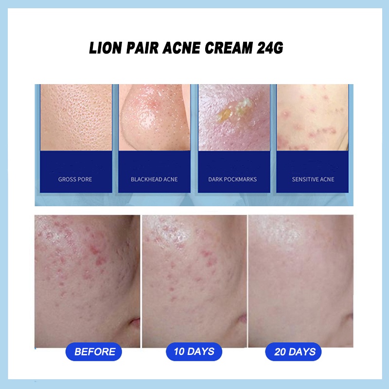 [COD] LION PAIR Acne Cream W 24g  Antibacterial Acne Face Krim W Anti Jerawat Original Jepang