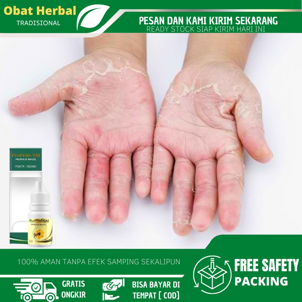Obat Kulit Telapak Tangan Mengelupas,  Obat Kulit Jari Tangan Mengelupas, Kulit Gatal Lecet Perih, K