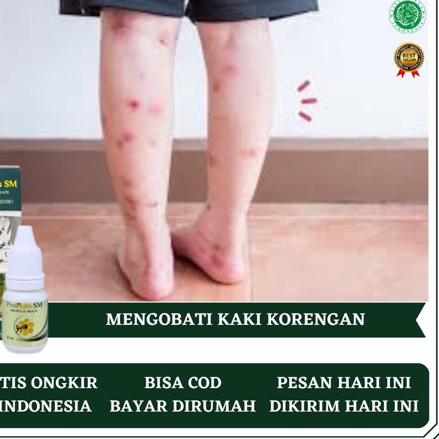 Diskon✔️Obat Kaki Koreng, Obat Kaki Koreng Darah Manis, Obat Koreng di Kaki, Obat Kaki Koreng Anak, 