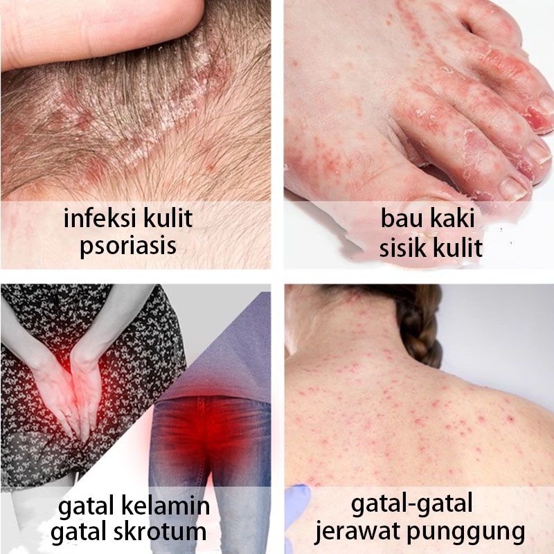 Salep gatal Obat gatal kulit Obat gatal paling ampuh Obat kurap paling ampuh 30ML Bahan alami / aman dan efektif / tidak menyebabkan iritasi Menekan rasa gatal dan bau / menghilangkan kurap seluruh bagian tubuh