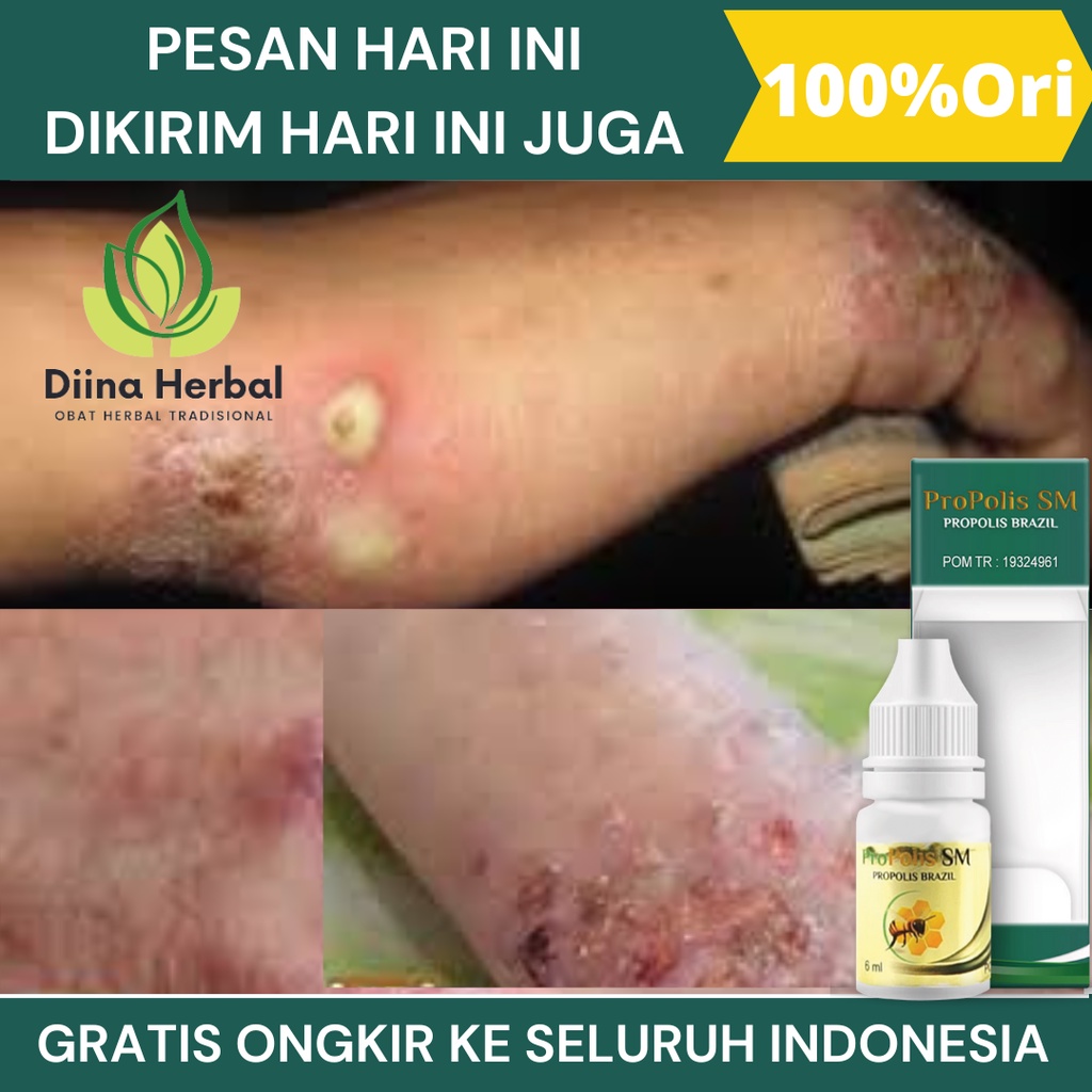 Obat Budug Anak Dewasa, Obat Budug Bernanah, Obat Borok Budug, Obat Penghilang Bekas Budug, Obat Bor
