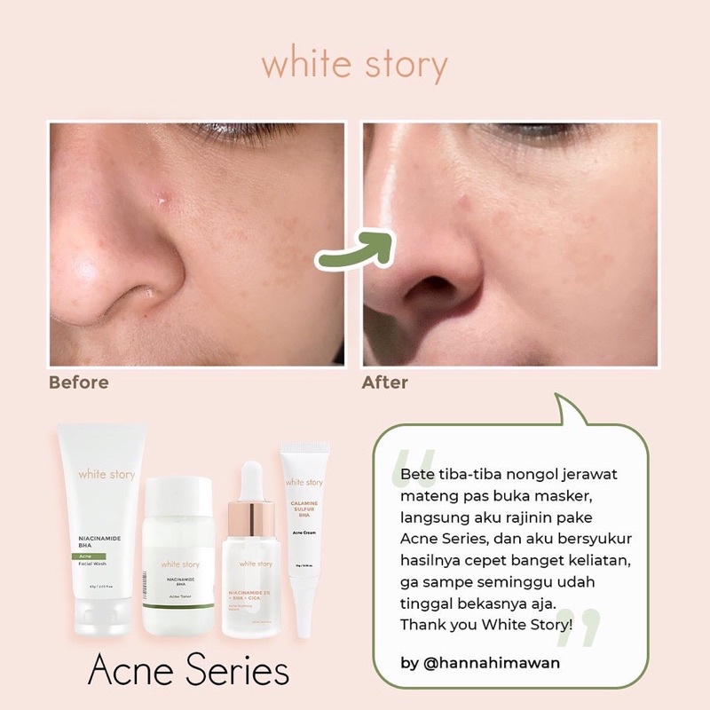 WHITE STORY Acne Facial Wash