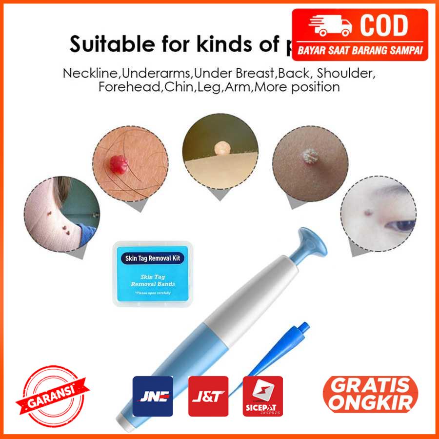 Alat Penghilang Kutil Painless Skin Tag Mole Removal Kit LGV40