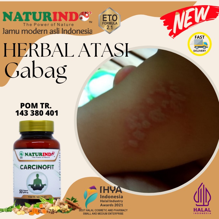 Naturindo Carcinofit Obat Gabag Dermatitis Ruam Merah Kulit Bentol Gatal Campak Carcinofit Naturindo