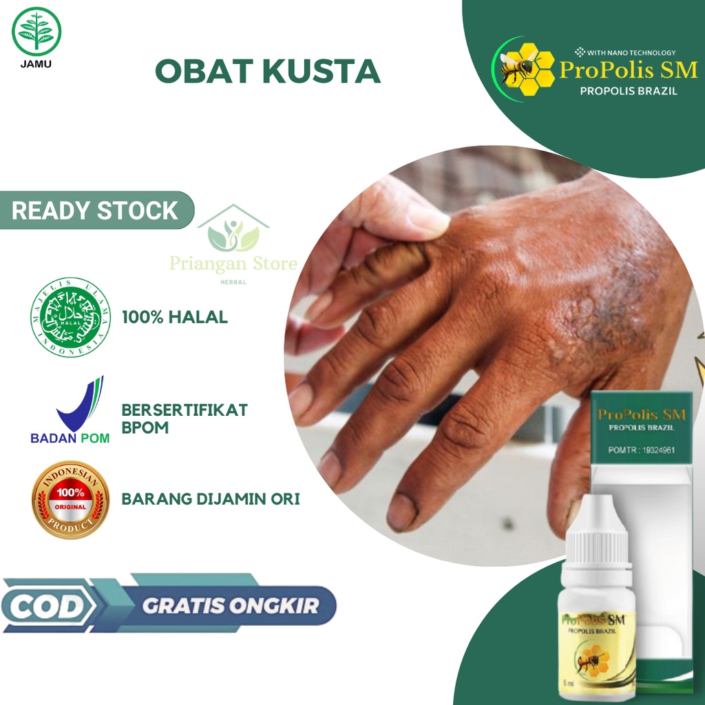 Obat Kusta, Obat Kusta Kering, Obat Kusta Basah, Obat Kusta Lepra, Obat Kulit Bersisik, Obat Bercak 