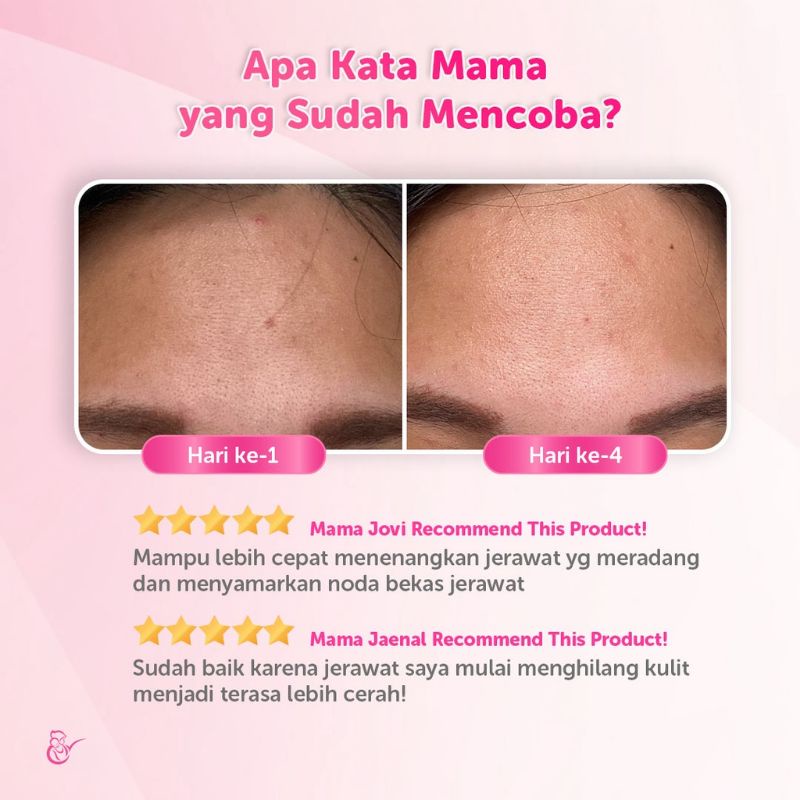 Mama's Choice Anti Acne Face Serum | Serum Wajah Berjerawat Aman untuk Ibu Hamil dan Ibu Menyusui