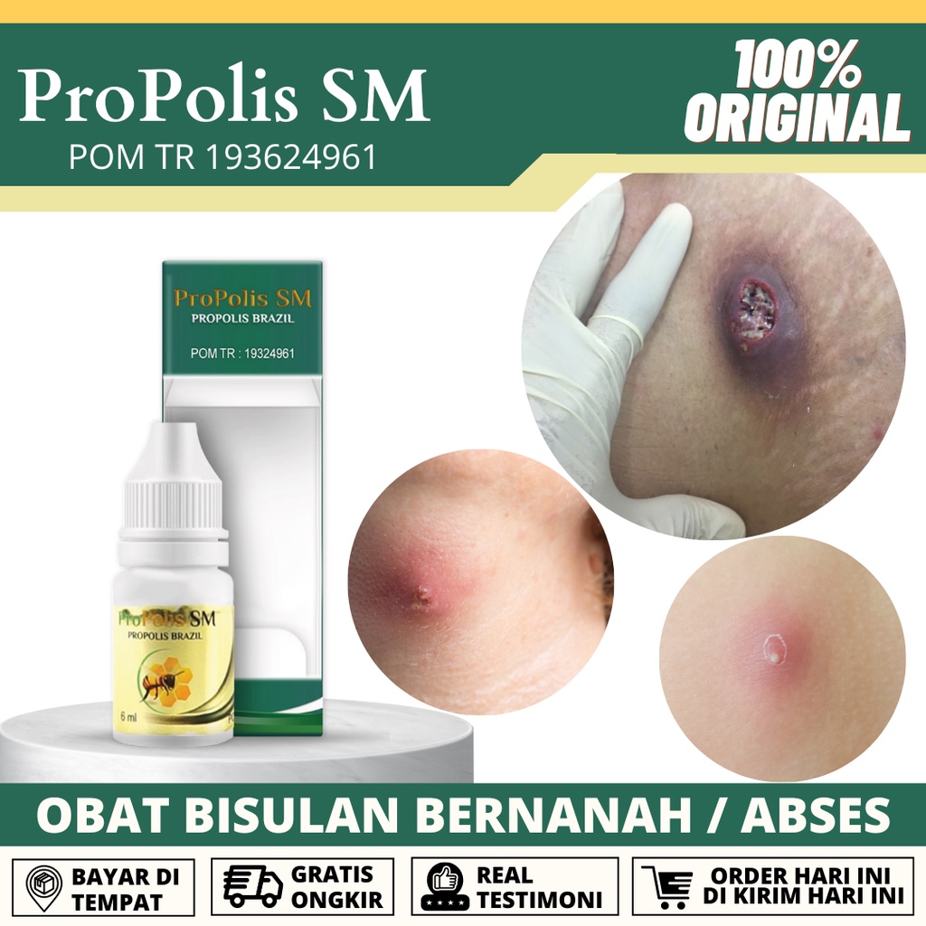 ProPolis SM 6ml - Obat Tetes Salep Bisul, Obat Bisul Di Pantat Bayi Anak Dan Dewasa, Benjolan Bernan