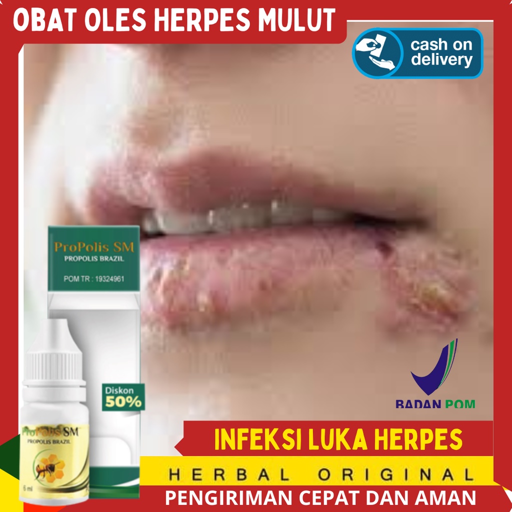 Salep Herpes Genital - obat oles untuk herpes di bibir - Muncul bintik merah di penis - Ruam-ruam be