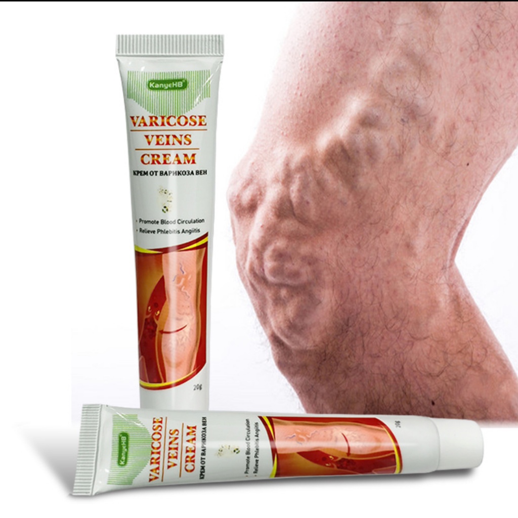 OBAT VARISES CREAM VARISES