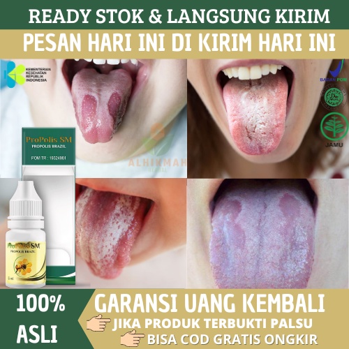 Obat Lidah Putih Pecah Pecah / Candidiasis, Sariawan Di Lidah, Lidah Putih Berjamur, Lidah Terasa Pa