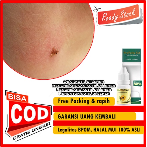 Propolis SM Herbal Tetes - Obat kutil di leher, menghilangkan kutil di leher, Penghilang kutil di le