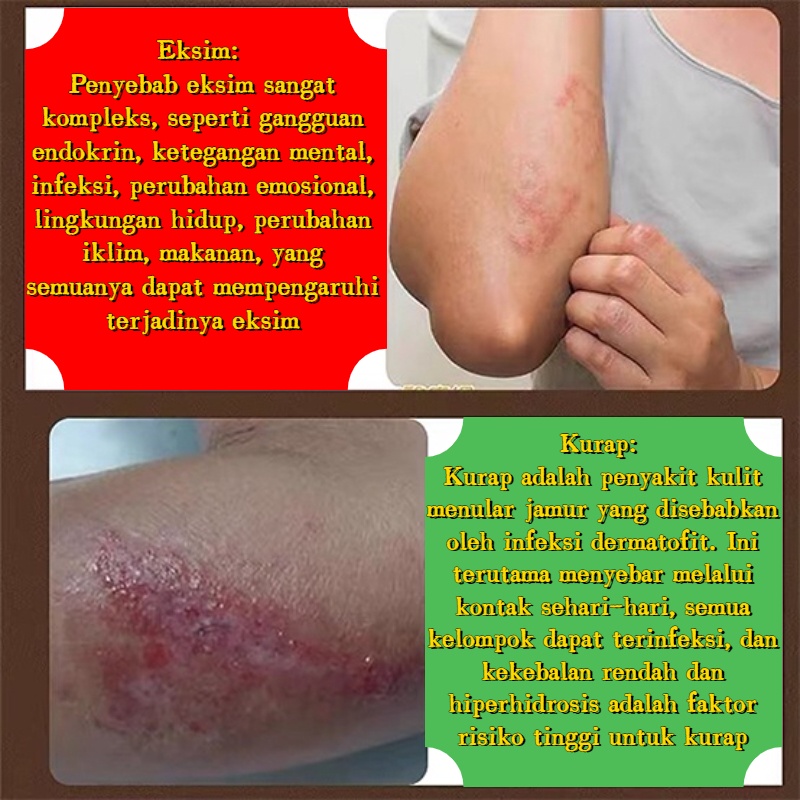 Salep gatal Salep eksim Salep kulit gatal Salep jamur kulit Obat salep gatal Obat salep psoriasis eczema cream salep gatal gatal