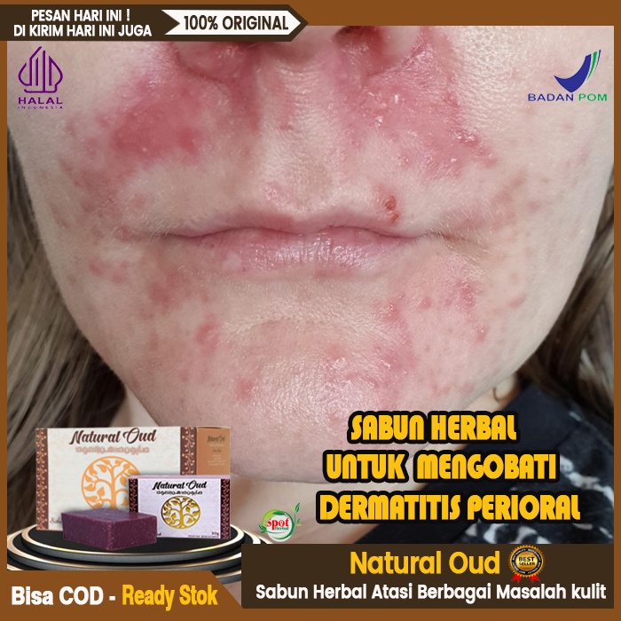 Sabun Untuk Dermatitis Kontak - Homecare24