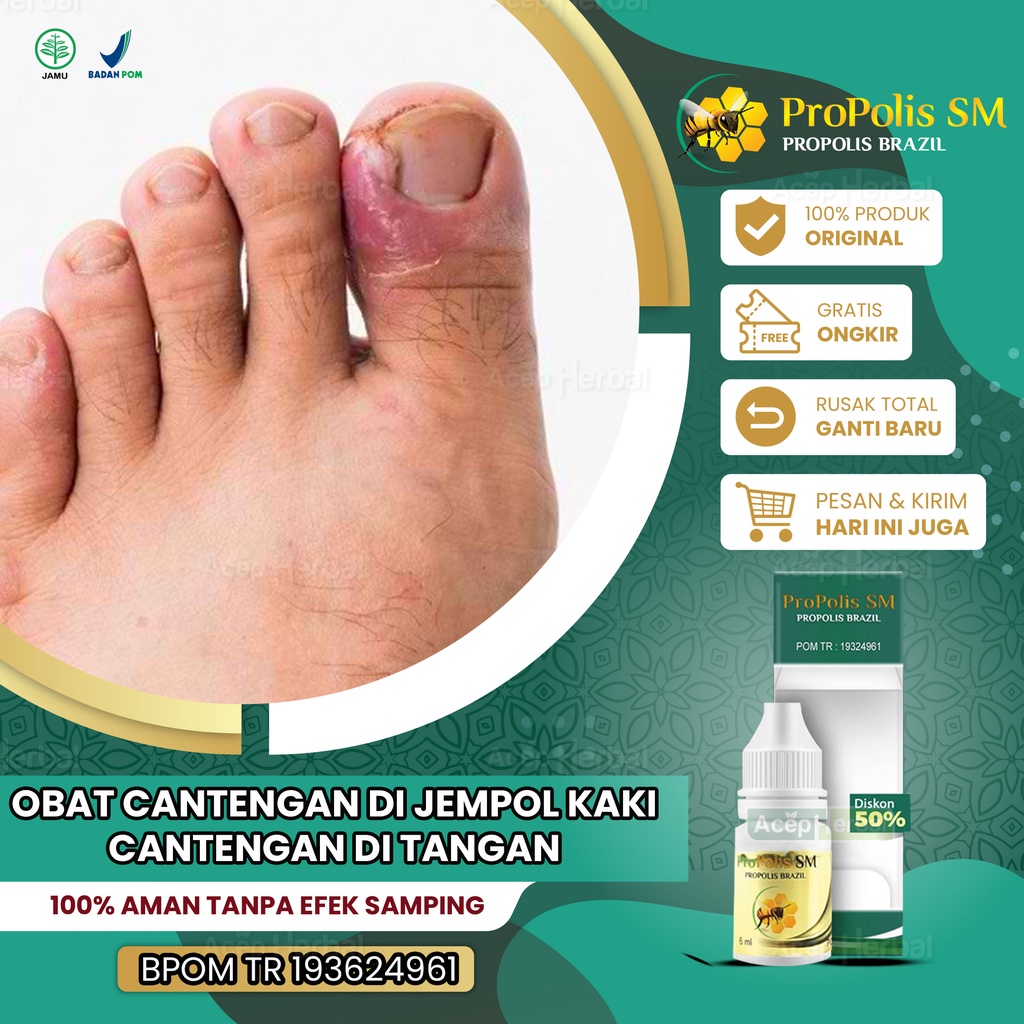 Jual Obat Cantengan Jempol Kaki Tangan Bengkak Dan Bernanah Kuku Rusak