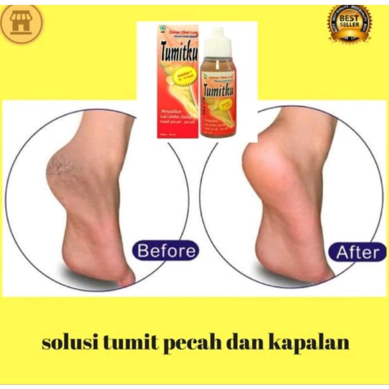 READY !! TUMITKU OBAT TUMIT PECAH PECAH DAN SOLUSI KAKI KAPALAN