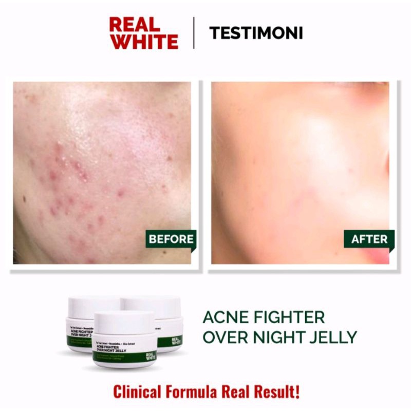 REAL WHITE Acne Fighter Over Night Jelly/Jerawat Meradang