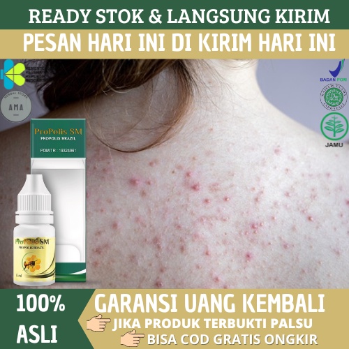Propolis SM - Obat Jerawat di Punggung, Di Dada, Di Wajah, Gatal Ruam Bruntusan Bintik Merah