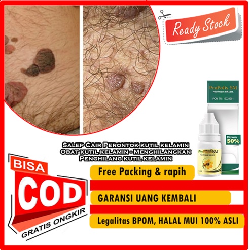 Salep Cair Perontok kutil kelamin - Obat kutil kelamin - Menghilangkan / Penghilang kutil kelamin Pr