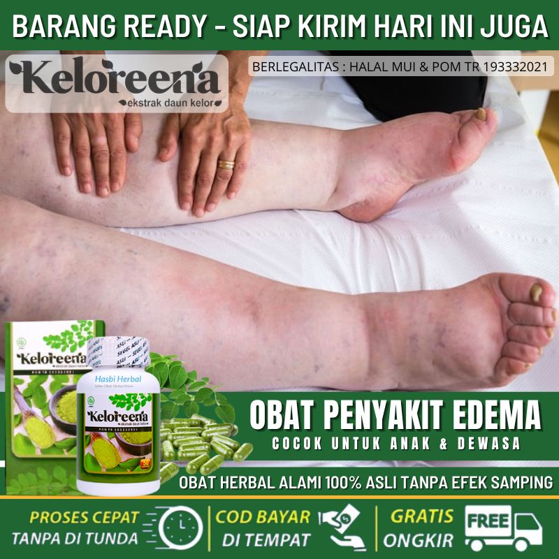 Obat Pengempis Kaki Kembung, Atasi Pembengkakan Edema, Obat Gangguan Edema, Kaki Besar Sebelah, Kaki