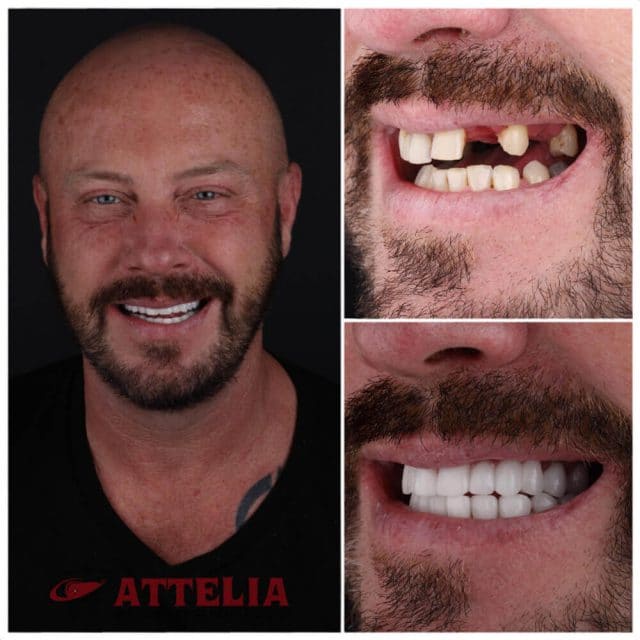 ORIGINAL Paket Atas Bawah Gigi palsu permanen kuat tinggal pasang snap on smile original asli pria w