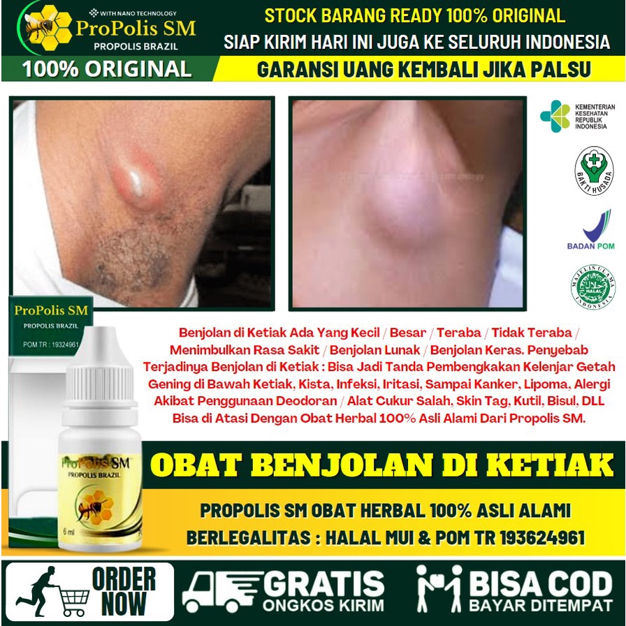 Obat Benjolan di Ketiak Herbal, Obat Benjolan di Ketek, Lipoma di Ketiak, Obat Ketiak Bengkak, Bisul