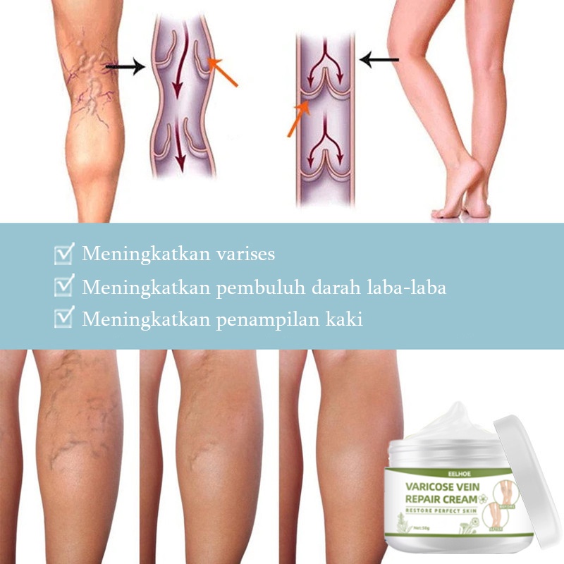 Terlaris !!! Varicose Veins Obat Varises Varikokel Bengkak Benjolan Buah Zakar Nyeri Testis Paling Ampuh Varicose Veins Treatment Cream/Obat Krim Varises Parises Tanpa Operasi