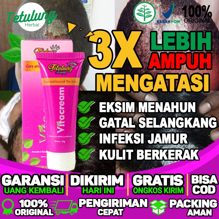 Salep Gatal Selangkangan Karena Jamur Salep Gatal Terbaik Salep Gatal di bagian kepala