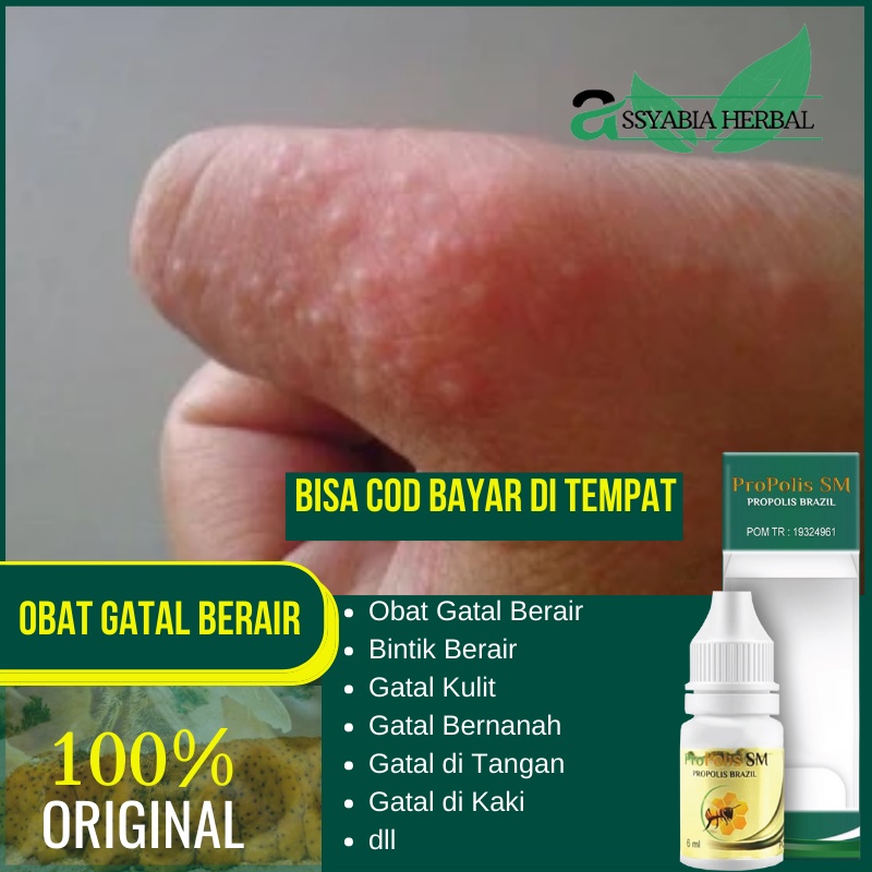 Obat Gatal Berair, Bintik Berair, Gatal Kulit, Gatal Bernanah, Gatal di Tangan, Gatal di Kaki | Prop