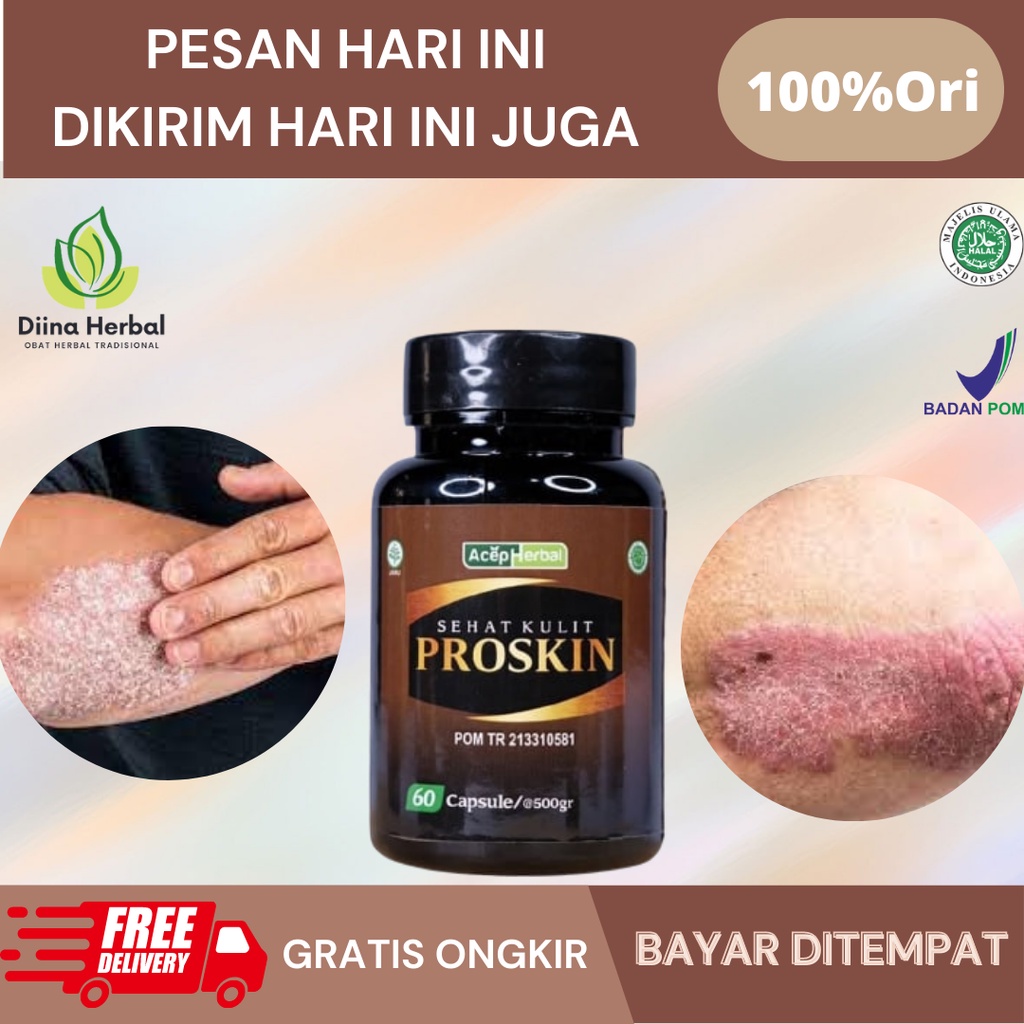 Obat Gatal Kulit Berjamur, Obat Psoriasis Menahun, Obat Penyakit Kulit Psoriasis, Obat Kulit Kepala 